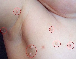 Вірус папіломи людини у немовлят і дітей старшого віку. Як уникнути зараження?