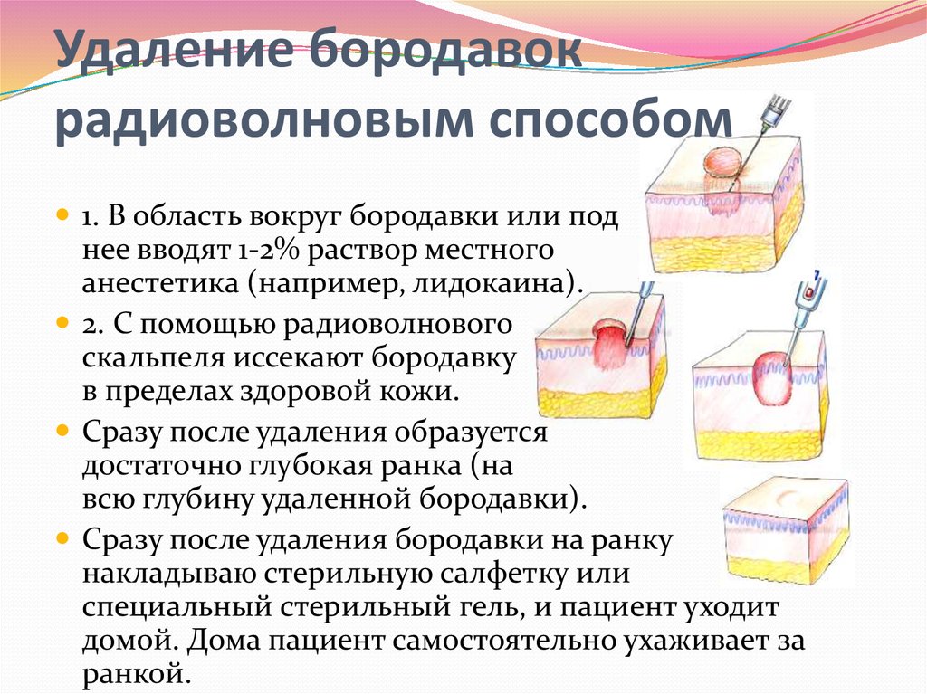 Видалення бородавок — який спосіб вибрати і наскільки це небезпечно?