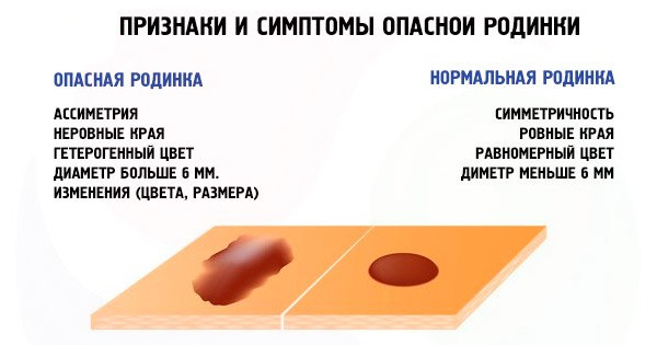 Виведення (випалювання) родимки — як це зробити і наскільки це шкідливо?