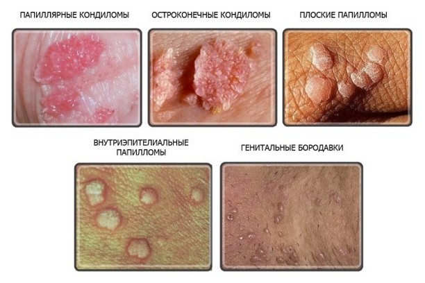 ВПЛ у чоловіка — 13 причин та особливості чоловічого вірусу папіломи