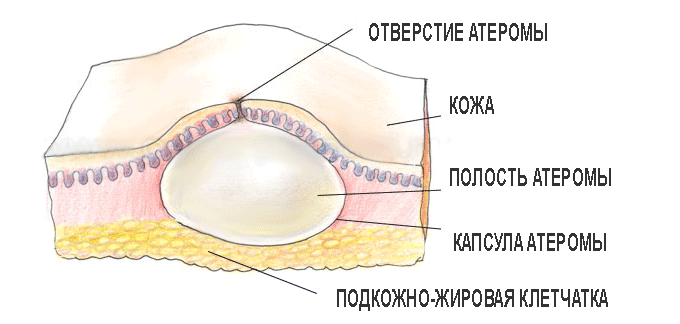 Як позбутися жировика на голові, до якого лікаря звернутися?