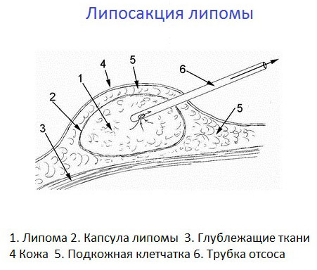 Як позбутися жировика на голові, до якого лікаря звернутися?