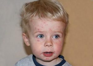 Як розвивається і передається стрептодермія? Як розвивається і передається стрептодермія?