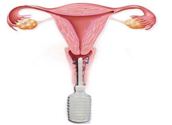 Як швидко вилікувати молочницю у жінок і у чоловіків